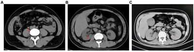 Delayed bilateral spontaneous renal rupture after surgery for unilateral upper ureteral calculi: a case report